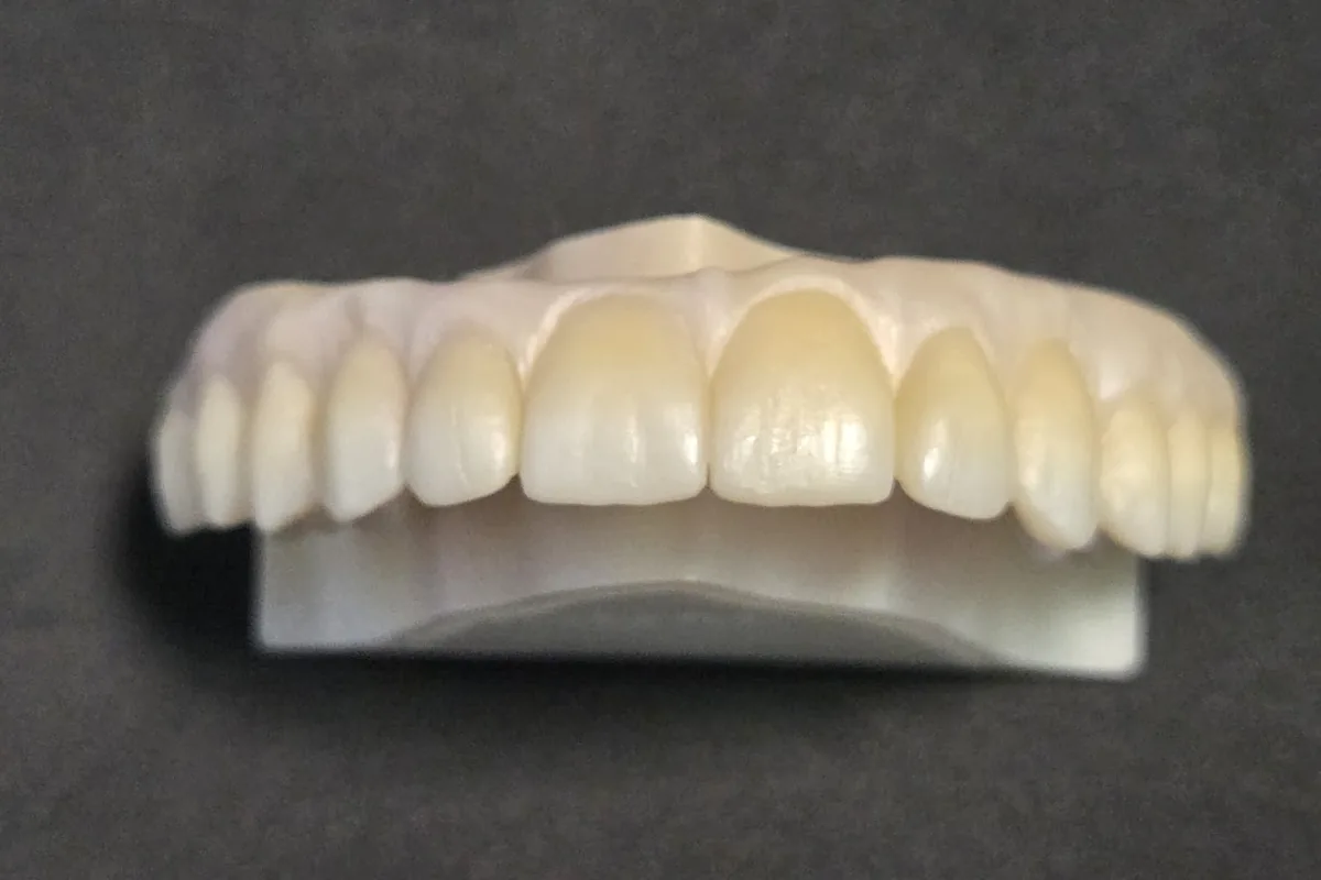 Toronto bridge in zirconia, vista frontale