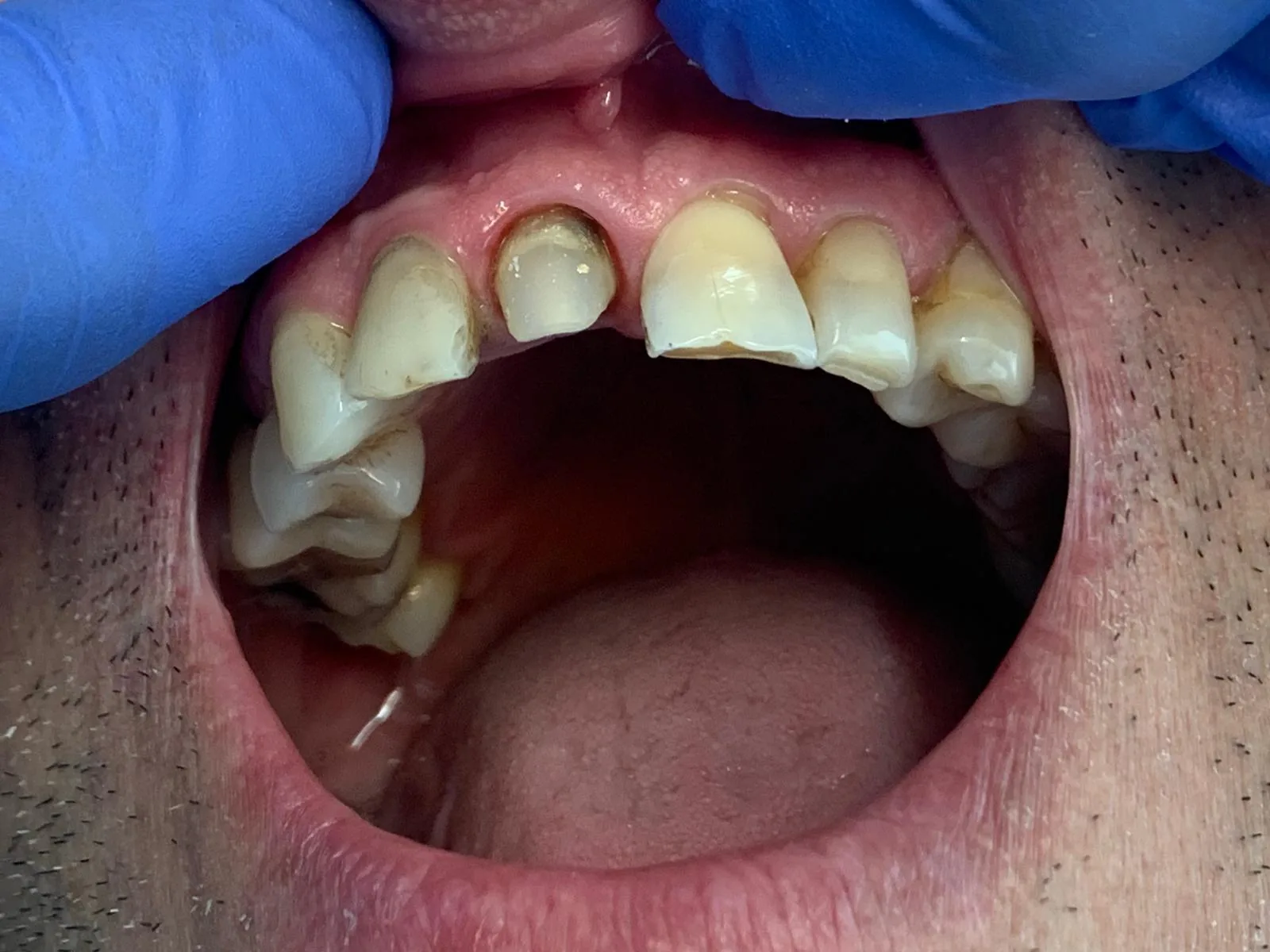 Caso 1: denti preparati