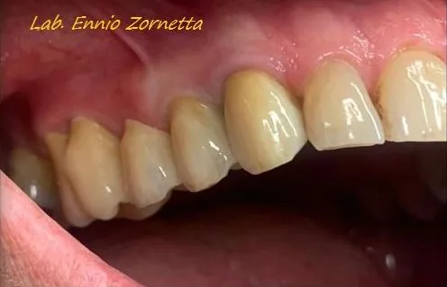 Ponte in zirconia in bocca