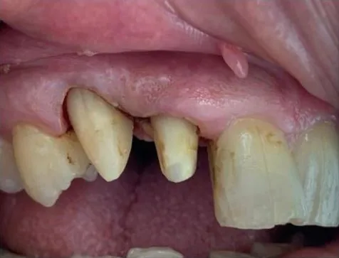 Denti preparati